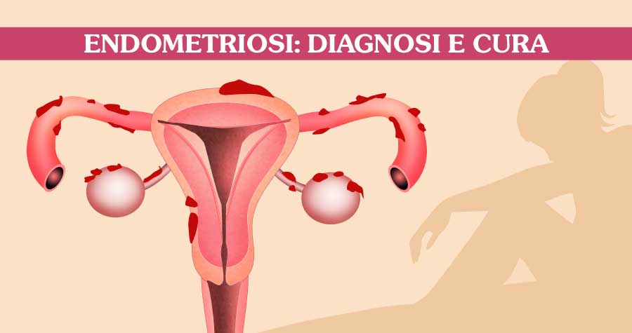 Miglior utilizzo dell' olio Cbd per Endometriosi